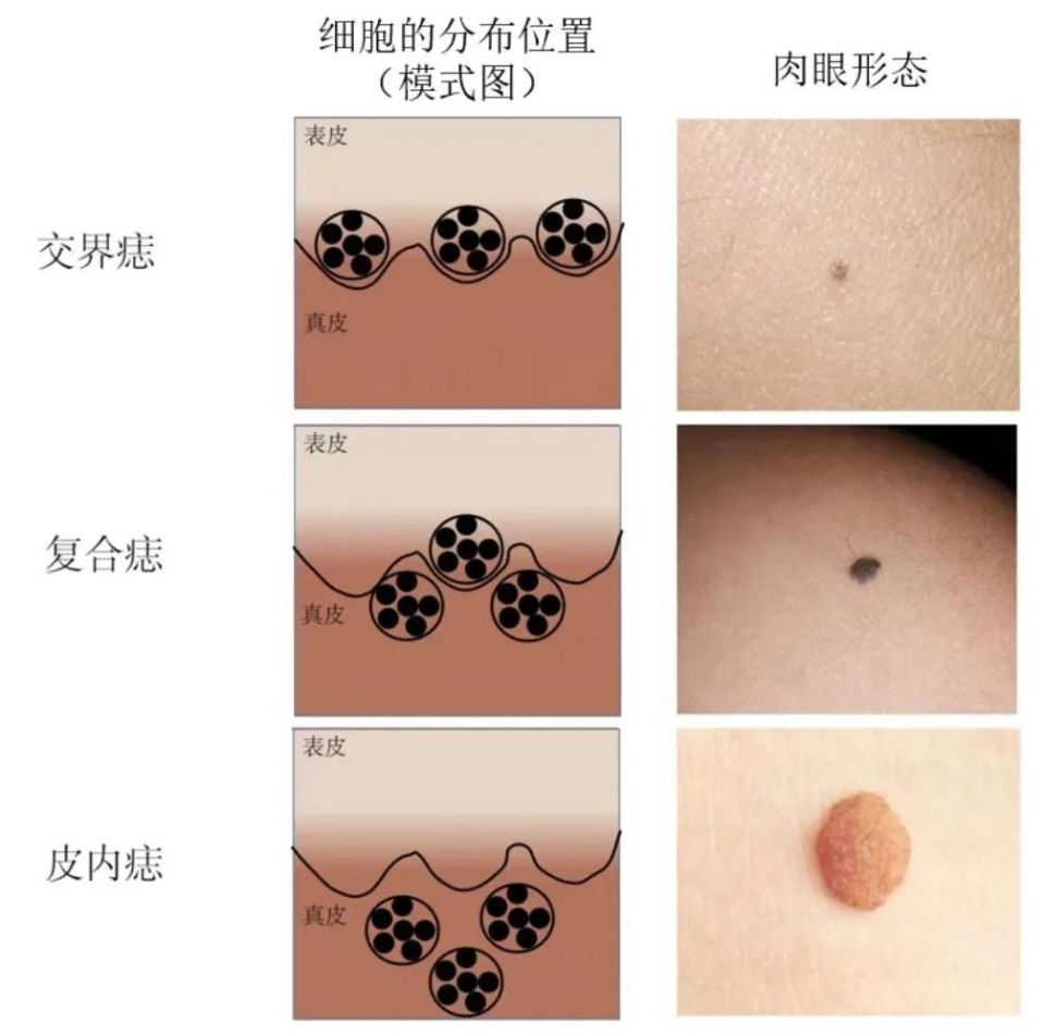 痣怎么形成的
